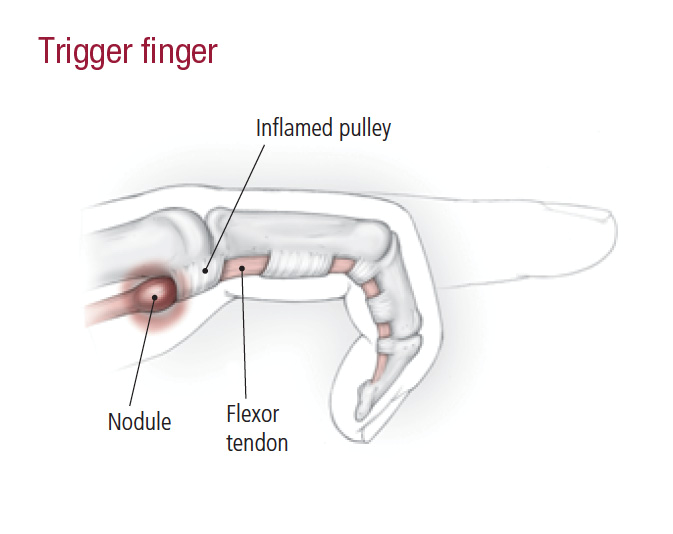 Trigger Finger: Causes, Symptoms, and Treatment Options