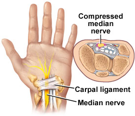 Recognizing the Symptoms of Carpal Tunnel Syndrome - Ortho Illinois